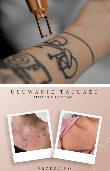 Laserowe usuwanie tatuażu — efekt przed i po, KD Beauty Zielona Góra